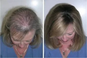 Hairstim